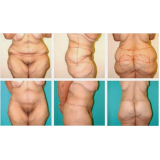 clínica de cirurgia plástica abdominal Taboão da Serra