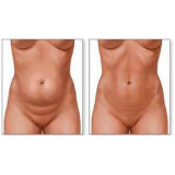 clínica de cirurgia plástica do abdômen Taboão da Serra