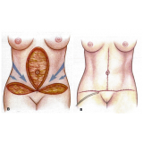 clínica de cirurgia plástica pós bariátrica Taboão da Serra