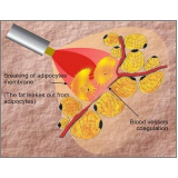 clínica de lipoaspiração a laser Santo Amaro