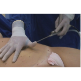clínica de lipoaspiração abdominal Santo Amaro