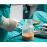 clínica de lipoaspiração para emagrecer Morumbi