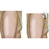 clínica de lipoaspiração para homens Taboão da Serra