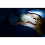 clínica de lipoaspiração para perder barriga São Paulo