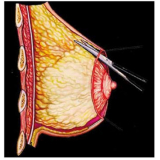clínica de mamoplastia aureola Morumbi