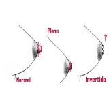 clínica de mamoplastia bico invertido Santo Amaro