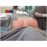 clínica de mamoplastia bilateral Morumbi