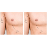 clínica de mamoplastia para homem Morumbi