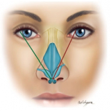 clínica de rinoplastia para agrandar nariz Taboão da Serra