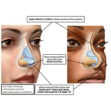 clínica de rinoplastia para empinar o nariz Santo Amaro