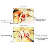 clínica de rinoplastia para nariz negroide Santo Amaro