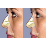 clínica de rinoplastia para rosto redondo São Paulo