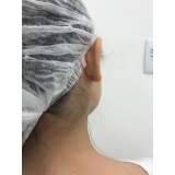clínica para cirurgia plástica orelha Vila Andrade