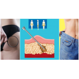 clínica para lipoaspiração para emagrecer Santo Amaro