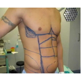 clínica para lipoaspiração para homens Morumbi