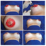 clínica para mamoplastia aureola Taboão da Serra