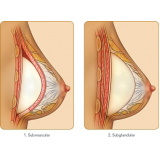 clínica para mamoplastia com prótese Morumbi