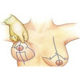 clínica para mamoplastia redutora Morumbi