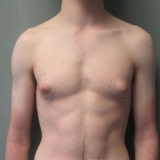 ginecomastia grau 1 preço Morumbi