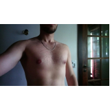 ginecomastia grau 1 Vila Andrade