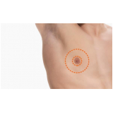 ginecomastia masculina cirurgia preço São Paulo