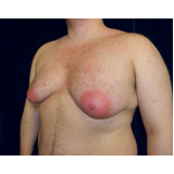 ginecomastia masculina preço São Paulo