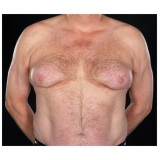 ginecomastia masculina valor Taboão da Serra