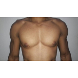 ginecomastia masculina Santo Amaro