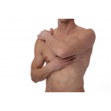 ginecomastia para homens Vila Andrade