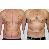 lipoaspiração abdominal masculina preço Morumbi