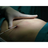 lipoaspiração abdominal preço Morumbi