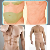 lipoaspiração de barriga masculina preço Santo Amaro