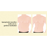 lipoaspiração de barriga masculina Santo Amaro