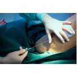lipoaspiração de barriga preço Taboão da Serra