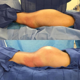 lipoaspiração do monte de vênus Morumbi