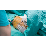 lipoaspiração e lipoescultura preço Vila Andrade