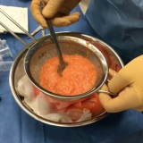 lipoaspiração e lipoescultura Morumbi