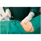 Lipoaspiração a Laser