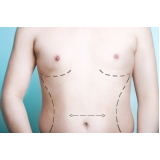 Lipoaspiração de Barriga Masculina