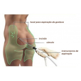 Lipoaspiração e Lipoescultura
