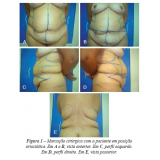 Lipoaspiração para Emagrecer