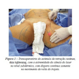 Lipoaspiração para Gordura Localizada