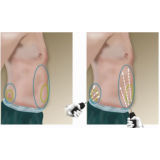 Lipoaspiração para Homens