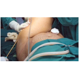 Lipoaspiração para Tirar Culote