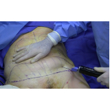 lipoaspiração para emagrecer preço Santo Amaro