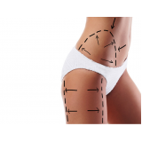 lipoaspiração para gordura localizada preço Morumbi