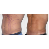 lipoaspiração para homens São Paulo