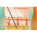 lipoaspiração para perder barriga Vila Andrade
