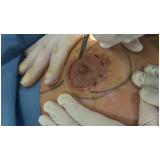 mamoplastia aureola preço Morumbi