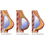mamoplastia com silicone São Paulo